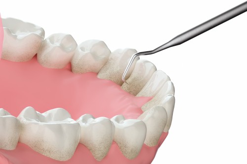 歯周病予防治療