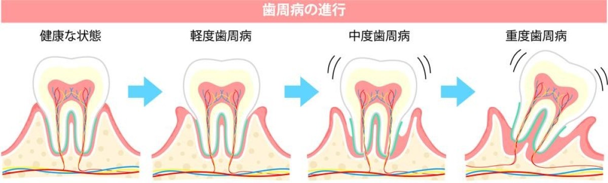 歯周病の進行度と治療法