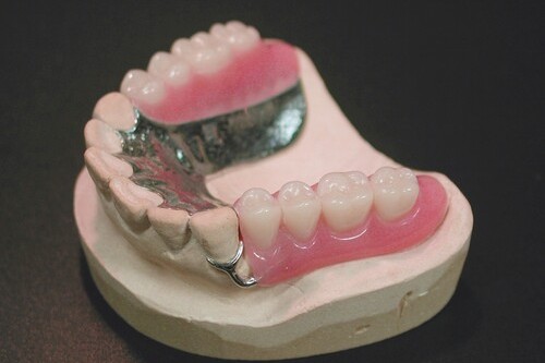 コバルトクロム床