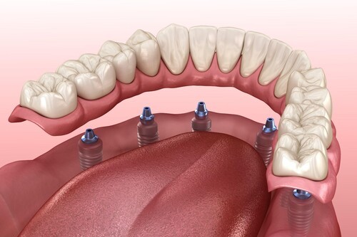 アタッチメント義歯