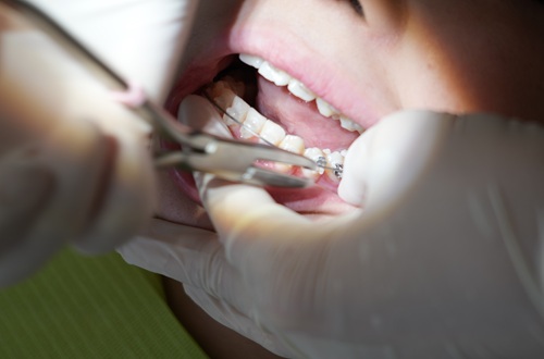 大人の矯正治療