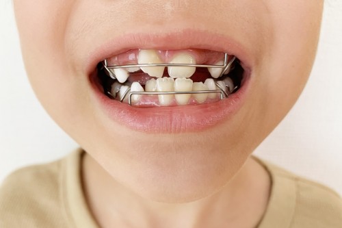 子供の矯正治療