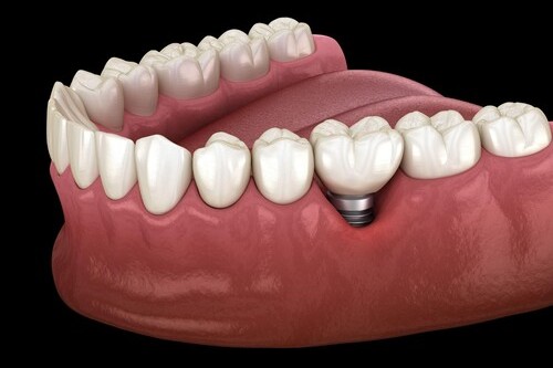 インプラント治療後はメンテナンスが重要